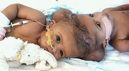 медицинско чудо лекари предричат смърт раждането сиамски близнаци живеят вече година видео