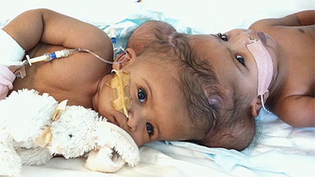 Медицинско чудо! Лекари предричат смърт след раждането на сиамски близнаци, те живеят вече 9-та година (Видео)
