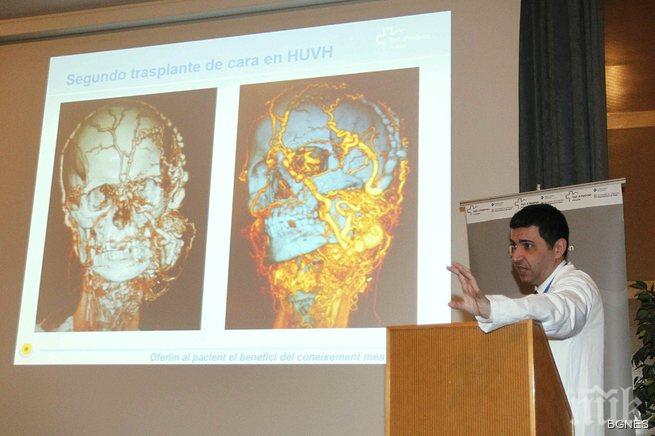 45 лекари в Испания извършиха най-сложната трансплантация на лице 