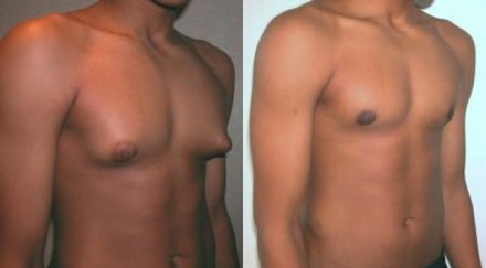 mъже сдобиват бюст телешко тъпкано женски хормони