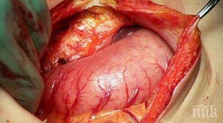 електронен нос изследва пациенти рак стомаха