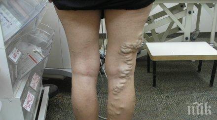 разширените вени израелско светило лекува революционен метод