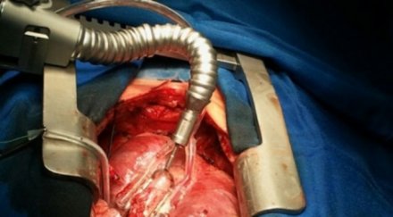 спирт сърцето спаси човешки живот