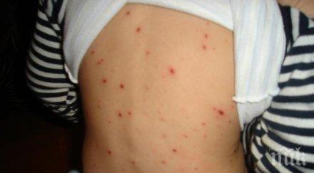 отчита увеличение броя болните варицела пловдивско