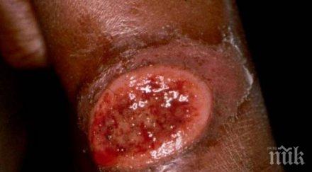 чревните инфекции увеличават два случая марсилка треска бургаско