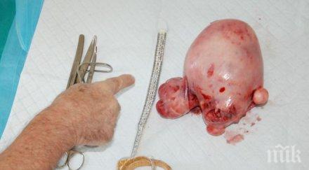 рекордна тегло миома отстраниха лекари харманлийската болница