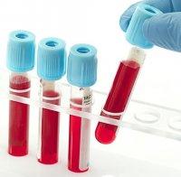 Кръвен тест дава надежда на болни от рак на гърдата