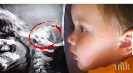 шок дете без мозък изрече мамо