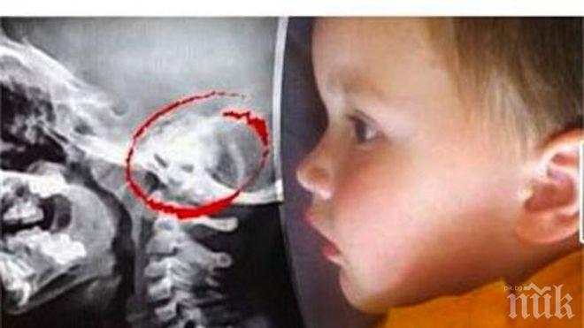 Шок! Дете без мозък изрече мамо