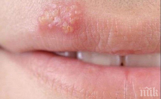 СЗО: Над 1/2 от населението на света под 50-годишна възраст е носител на вируса на херпеса 