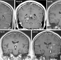 Mъж е бил инфектиран с рак от паразитна тения в тялото му