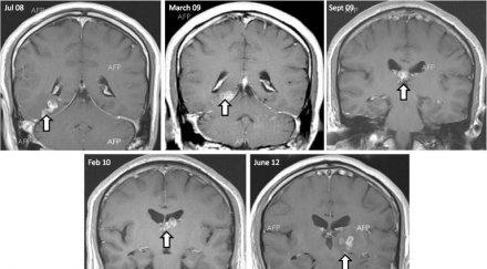 mъж бил инфектиран рак паразитна тения тялото