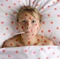 Скок на заболеваемостта от варицела и грип отчита Здравната инспекция