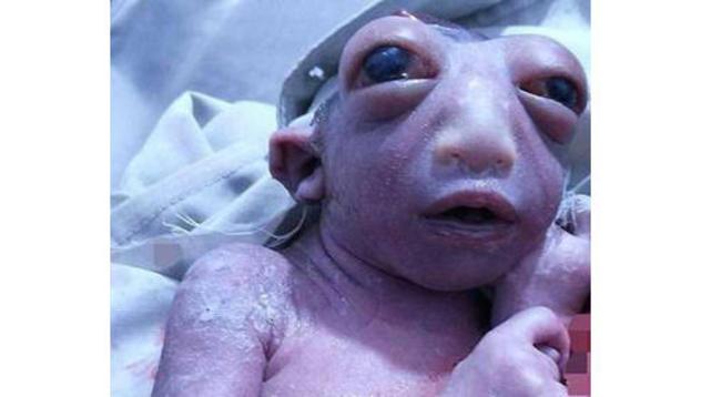 ЗЛОВЕЩО! Момиче с половин глава се роди в Индия, очите му са изцъклени