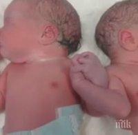 Сиамски близнаци успешно разделени в Швейцария осем дни след раждането