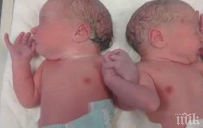Сиамски близнаци успешно разделени в Швейцария осем дни след раждането