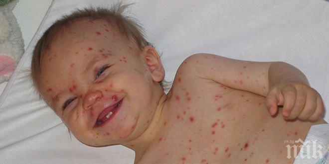 Бум на варицела във Врачанско