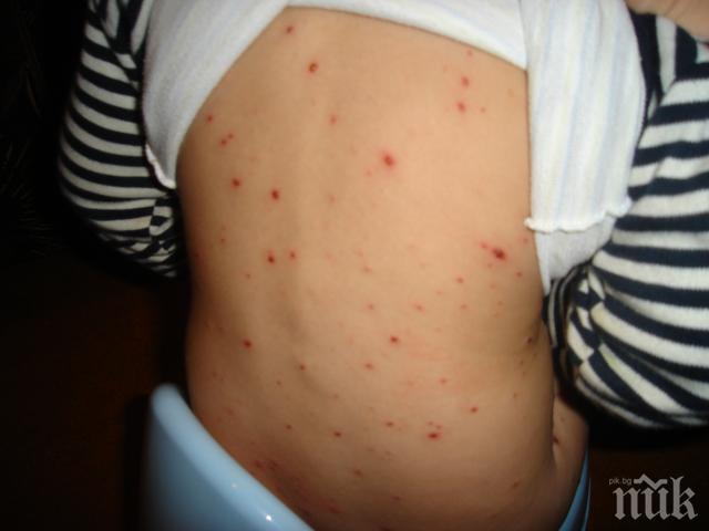 Шарка плъзна в детските градини в Хасково, варицелата поваля 40 деца седмично