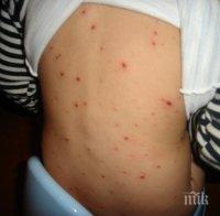 Бум на болните от шарка във Враца
