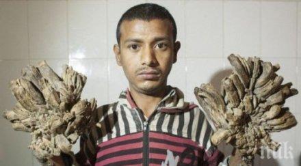 успешно опериран човекът дърво бангладеш