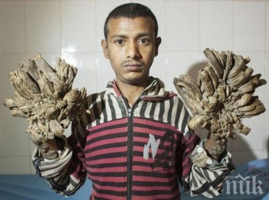 Успешно е опериран човекът-дърво в Бангладеш