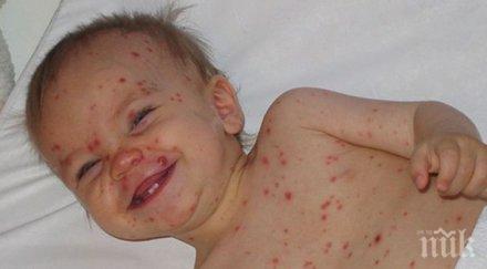 натръшкани варицела плевенско