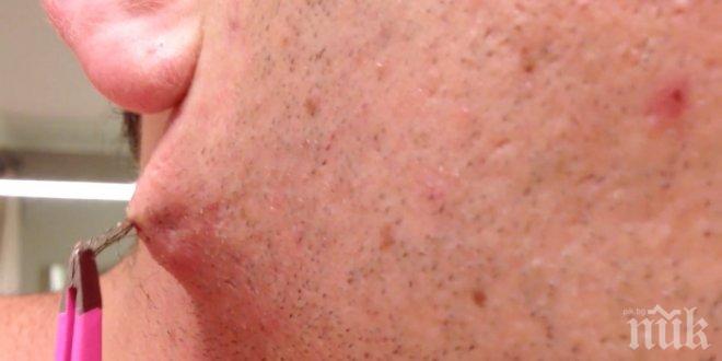 Това изглежда като крак на паяк, който живее под кожата му. Когато той го извади, не можеше да повярва на очите си! 