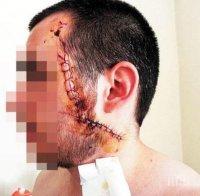 Кърваво меле в благоевградска дискотека! Чужденец заби бутилка бира в главата на младеж