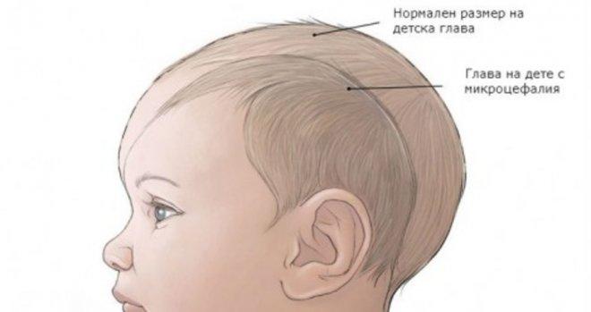 Първи случай на микроцефалия, предизвикана от зика