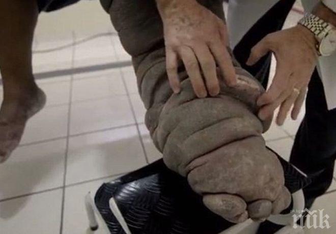 ШОКИРАЩА ДРАМА! След ухапване от комар: Мъж бавно се превръща в слон