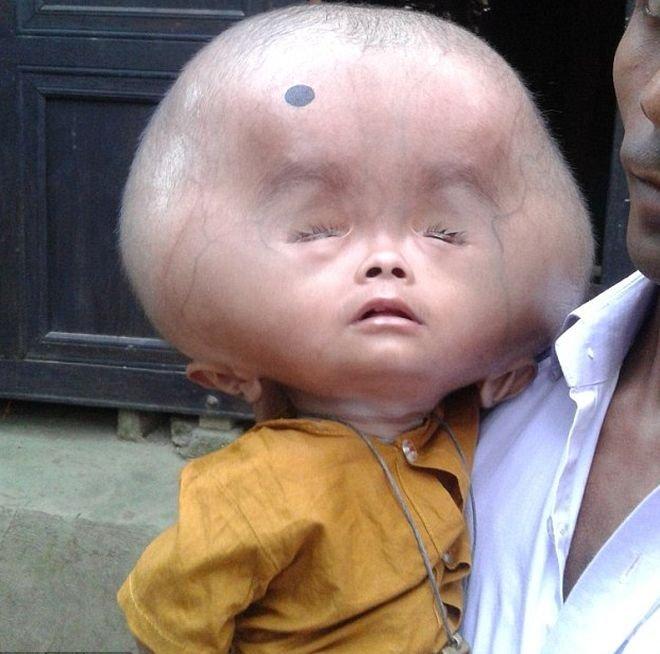 Не е за вярване! Главата на 2-годишно дете не спира да расте, вече е 9 килограма (СНИМКИ 18+)