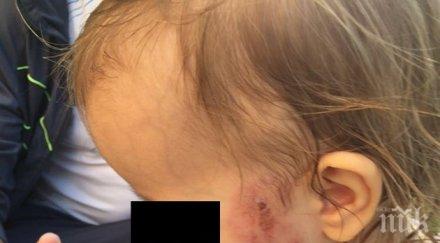 ужасяваща гледка нахапаха дете забавачката