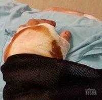 Мъжът с пришитата ръка проговори: Медиците направиха чудо (ВИДЕО)