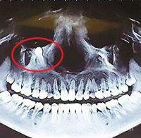 Уникален случай: Зъб на китайка расте към окото й, хирурзи го извадиха