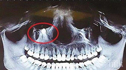 уникален случай зъб китайка расте окото хирурзи извадиха