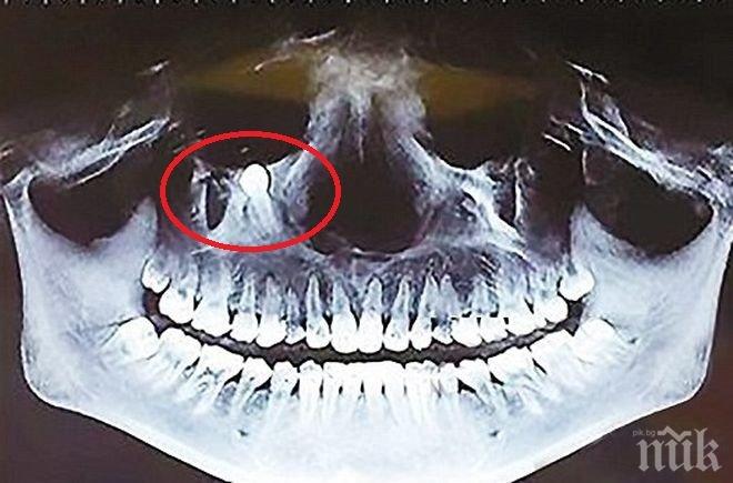 Уникален случай: Зъб на китайка расте към окото й, хирурзи го извадиха