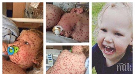 лекари пълен шок дете постъпи лечение потресаващ тип варицела страховити снимки видео