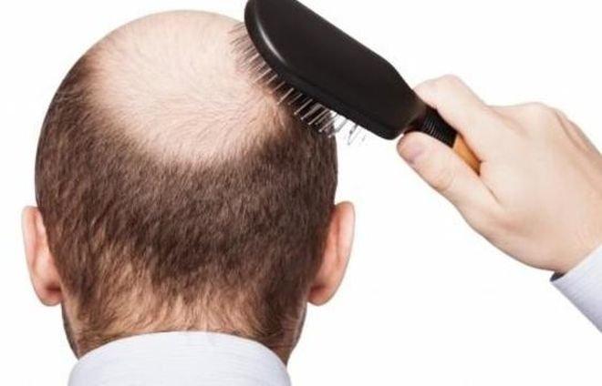 СУЕТА! Дупнишки полицай изтегли 2200 евро кредит, за да си присади коса