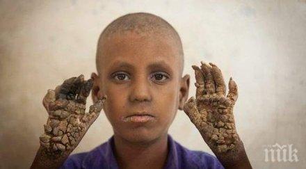 потресаващ случай момче бангладеш превръща дърво уникални снимки