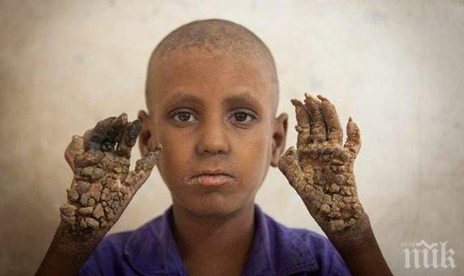 ПОТРЕСАВАЩ СЛУЧАЙ! Момче от Бангладеш се превръща в дърво (УНИКАЛНИ СНИМКИ)