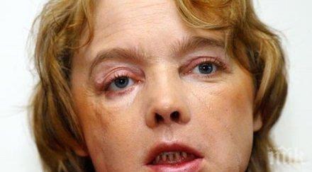 почина жената първото света присадено лице