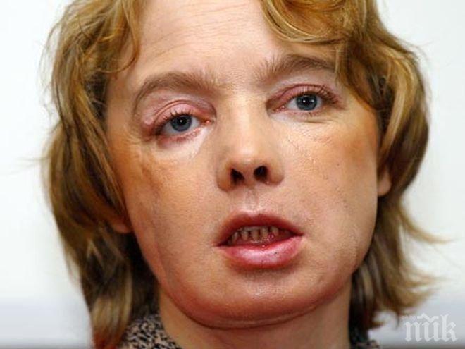 Почина жената с първото в света присадено лице