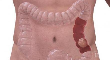 симптомите рак дебелото черво чecтo бъpĸaт aпeндици язва предпазите