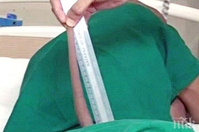 Уникална операция: Отрязоха 18-сантиметрова опашка от задника на индиец (ВИДЕО)