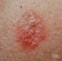 ПРОБИВ! С рака ще може да се живее като с хронично заболяване