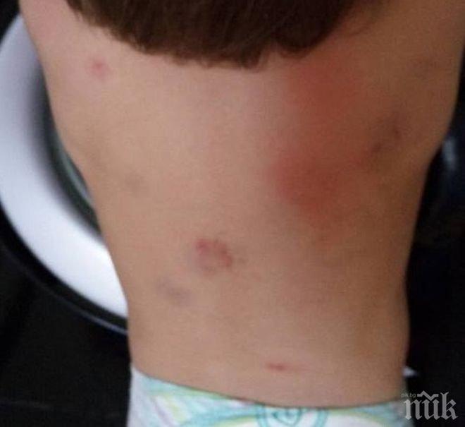 Майка в шок: Върнаха дъщеря ми от детската градина, нахапана зверски на 7 места (СНИМКИ)