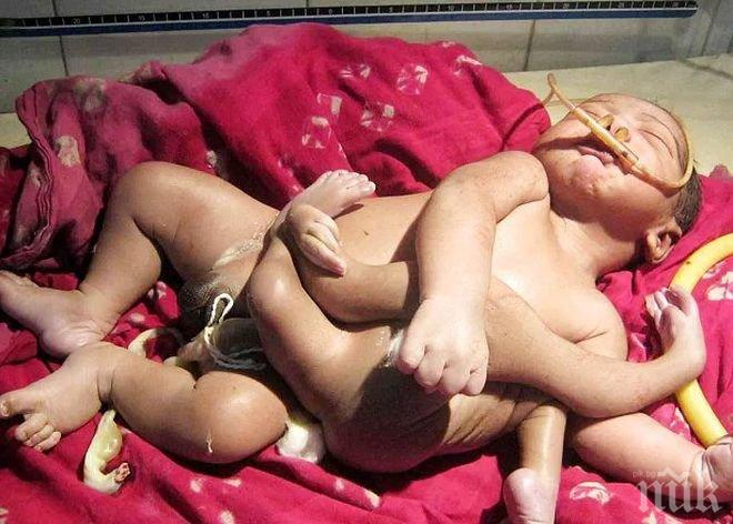 Уникално: Дете с четири крака се роди в Мозамбик