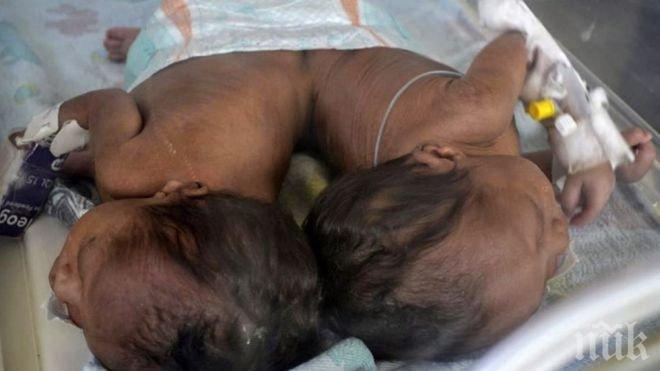 Разделиха успешно разделиха сиамски (СНИМКИ)