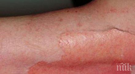 тотален кошмар кожата жена свлича парцали развила синдрома лайл обикновени хапчета