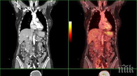 чудо първи път нас излекуваха пациент разсейки рак костите късметлията шефът клиника малинов